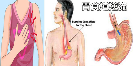 「火燒心」痛苦難當？不做九件事、多吃「7種養胃食療」，自癒「胃食道逆流」不求人！