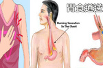 「火燒心」痛苦難當？不做九件事、多吃「7種養胃食療」，自癒「胃食道逆流」不求人！