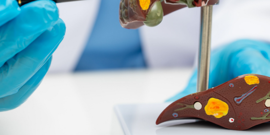 台灣脂肪肝人口超過3成！治療希望竟是 「瘦瘦筆」？ 醫證實：有望改善肝纖維化