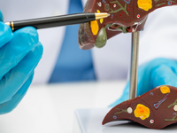 台灣脂肪肝人口超過3成！治療希望竟是 「瘦瘦筆」？ 醫證實：有望改善肝纖維化