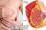 「乳房腫脹」請速就醫！當心是乳癌患者都有的「乳腺增生」，切記「兩件事」不做解除雙峰危機！