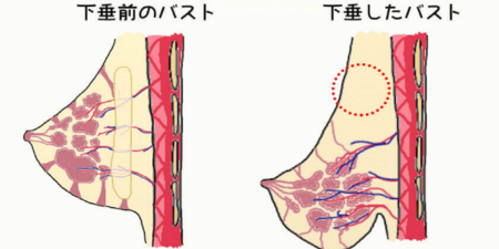 婦科醫師親授：搶救「胸部下垂」只要兩招！「每天5分鐘」豐胸、遠離鬆弛，找回堅挺雙峰