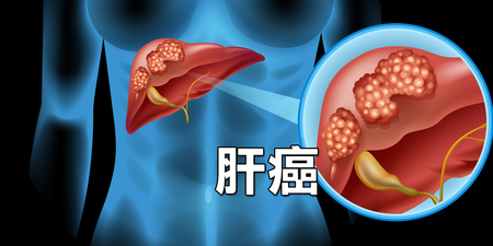 30到60歲最盛行，「肝癌」潛在體內的九大徵兆，活血去瘀、消除腫瘤的驚人食療法公開！