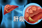 30到60歲最盛行，「肝癌」潛在體內的九大徵兆，活血去瘀、消除腫瘤的驚人食療法公開！