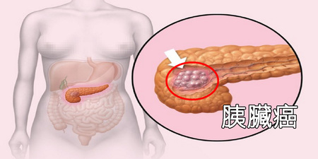 「胰臟癌」發病後平均存活「不到半年」：「十大風險因素」一秒自測，符合一項就必須小心！