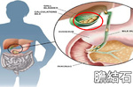 「上腹疼痛」非胃病，竟是「膽結石」在作怪！女性更需當心｜每日健康Health