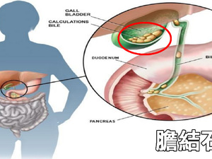 「上腹疼痛」非胃病，竟是「膽結石」在作怪！女性更需當心｜每日健康Health