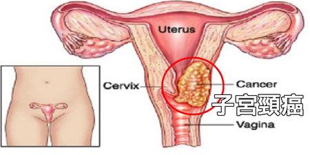 久坐竟會導致「子宮頸癌」？「七大成因」女性必知｜每日健康Health