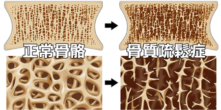 當心減肥減出「脆骨頭」，五大錯誤行為加速骨質流失｜每日健康 Health