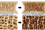 當心減肥減出「脆骨頭」，五大錯誤行為加速骨質流失｜每日健康 Health