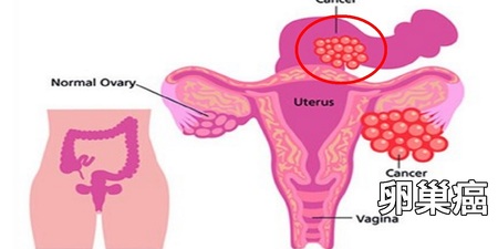 女人必看：多吃四種食物，「卵巢癌」發生率降低75%｜每日健康 Health