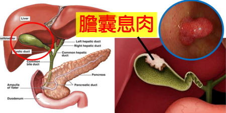 莫名腹痛別忽視，「膽囊息肉」竟是罹癌前兆！「防癌五招」杜絕癌變增生！｜每日健康Health