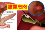 莫名腹痛別忽視，「膽囊息肉」竟是罹癌前兆！「防癌五招」杜絕癌變增生！｜每日健康Health