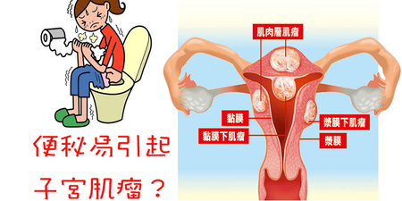 經血過多、容易便秘，你可能得了子宮肌瘤！愛自己的身體，來認識「三種肌瘤」吧！｜每日健康Health