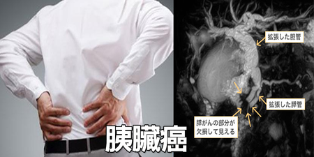 發生率等同死亡率！「胰臟癌」六大徵兆別當作小事｜每日健康 Health