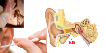 「耳鼻喉科」教授告訴你：「耳垢」不是垢！三要訣：別掏、別挖、別清理！