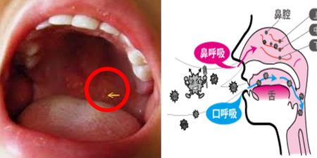 千萬別再用「嘴巴」呼吸！扁桃腺和內臟器官都是被「吸」壞的，你連吐氣都吐錯了！