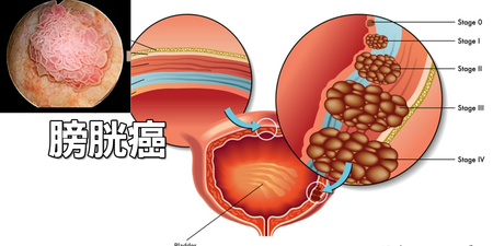 尿急、腰痛、水腫？「膀胱癌」細胞擴散無痛感，八大癌變徵兆千萬注意｜每日健康 Health