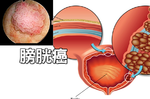 尿急、腰痛、水腫？「膀胱癌」細胞擴散無痛感，八大癌變徵兆千萬注意｜每日健康 Health