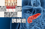 存活率不到5%！「牙周病」竟是「胰臟癌」前兆，8個潛在症狀是「胰臟」癌變警訊｜每日健康Health