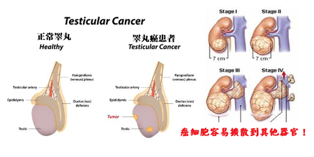 男性的卵巢癌「睪丸癌」檢測三步驟！這類人發生機率高出「3到14倍」！｜每日健康Health