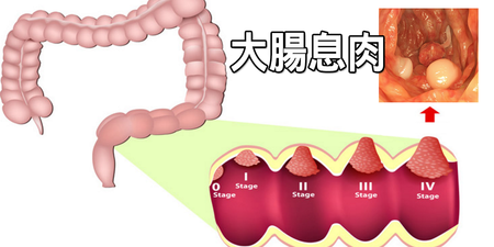 年奪5000命！「大腸癌」直到末期無明顯病症，一秒學會「抗癌六部曲」拒絕腫瘤息肉纏身｜每日健康 Health