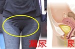 台灣四分之一女性飽受「漏尿」困擾！「一做四不吃」防堵滲尿、動作再大也不怕漏一滴尿｜每日健康Health