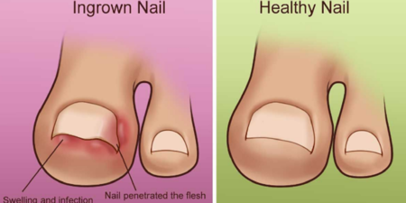 「腳趾甲內嵌」真的很痛苦！4個護理常識一定要知道，避免嵌甲惡化！
