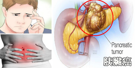 長期「頭痛」竟是「胰臟癌」前兆：「六大警訊」一秒自測，「三吃三不吃」顧好胰臟健康！｜每日健康Health