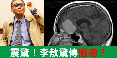 (新增經紀人發言)名嘴「李敖」驚傳罹患「惡性腦瘤」僅剩三年可活！認識「腦腫瘤」與它的「十種症狀」｜每日健康Health