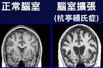 歐美與「帕金森氏症」齊名，發病「性命即倒數」的「杭廷頓氏症」！ 從「三方面」判斷病情，「兩種人」要注意｜每日健康Health