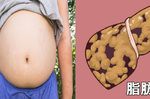 患「脂肪肝」不忌口，當心糖尿病、「肝癌」都來找！營養專家揭開「四大原則」保肝、戰勝脂肪｜每⽇健康Health