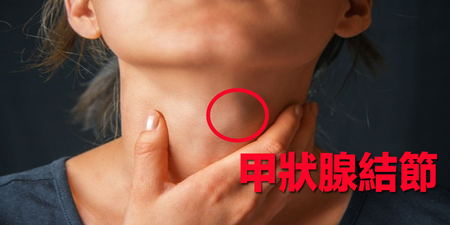 脖子「腫腫的」時好時壞？當心「甲狀腺結節」癌變！隱藏危機讓你一次看懂！｜每日健康Health