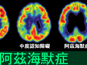 「阿茲海默症」是可以預防的！從運動、社交「六個生活習慣」開始做起！這樣飲「酒」也有幫助？｜每日健康Health