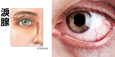 「乾眼症七症狀」命中了幾項？眼球二寶「溫水、椰子油」眼球酸溜溜變水溜溜！｜每日健康Health