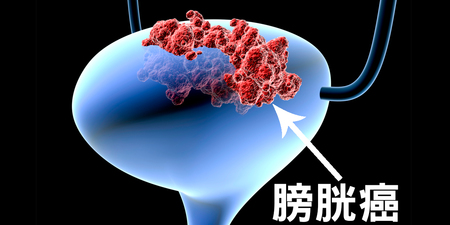 「經血」是「膀胱癌」前兆？不可不知膀胱癌化「四大警訊」，女性這樣做風險增五成｜每日健康Health