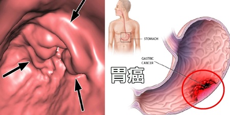 腹脹、噁心非小事！「四種症狀」恐是「胃癌」早期警訊，破壞「胃黏膜」的元兇竟是它！｜每日健康 Health