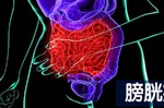 頻尿、血尿非小事！膀胱癌【五大早期徵兆】易混淆，「8成」患者發現時已錯失黃金治療期！｜每日健康Health