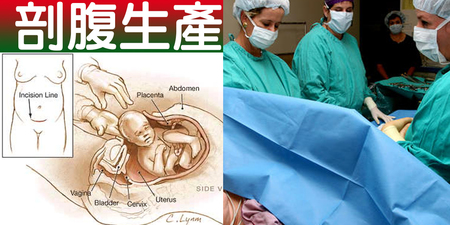 「剖腹產」的「五種副作用」！別讓「產婦、胎兒」為這藉口動刀賭命！｜每日健康Health