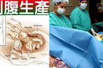 「剖腹產」的「五種副作用」！別讓「產婦、胎兒」為這藉口動刀賭命！｜每日健康Health