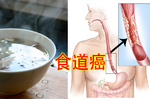 小心燙！消化黏膜不耐熱，超過耐熱溫度恐致【食道癌】！｜每日健康Health