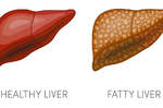 瘦子也會有「脂肪肝」！記下病因、症狀，及早發現避開「肝硬化」、「肝癌」｜每日健康 Health