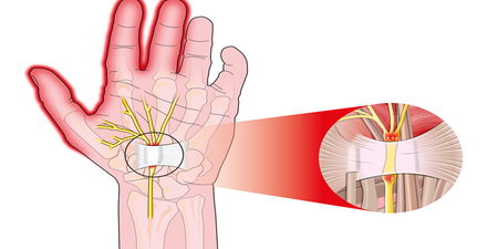 手麻、無力？兩招居家療法、練習運動拯救「腕道症候群」｜每日健康 Health