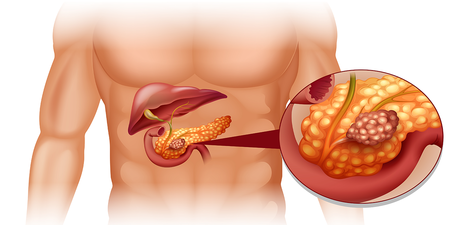 「胰臟癌」存活率低！「五大早期症狀」、「五招補救措施」保命要知道｜每日健康 Health