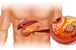 「胰臟癌」存活率低！「五大早期症狀」、「五招補救措施」保命要知道｜每日健康 Health