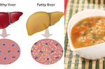 「脂肪肝」吃對食物就能救！2步驟「養生湯粥」增強免疫力、擊退有害自由基｜每日健康 Health