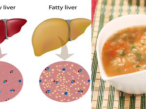 「脂肪肝」吃對食物就能救！2步驟「養生湯粥」增強免疫力、擊退有害自由基｜每日健康 Health