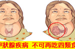 杜絕惡化！「甲狀腺」疾病應避開「四類食物」，越吃脖子越腫｜每日健康 Health