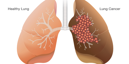 背痛、關節痛恐是「肺癌」！「八大警訊」不吸菸也要知｜每日健康 Health