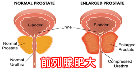 九成男性患有「前列腺肥大」、頻尿！症狀、「無痛療法」一秒學｜每日健康 Health